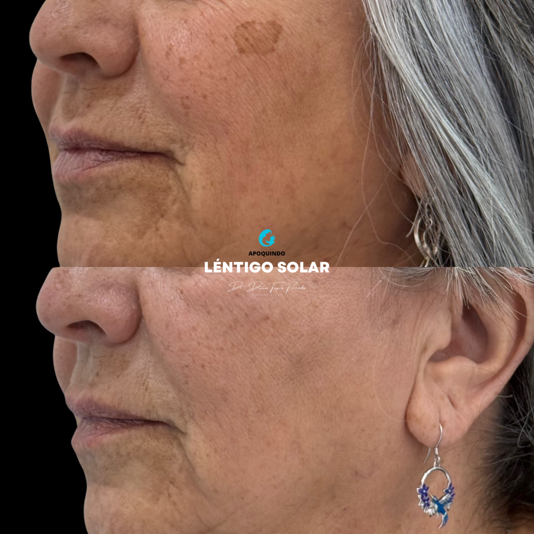 Láser de Picosegundos